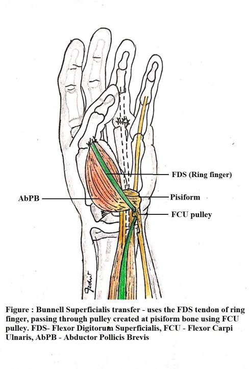 Bunnels superficialis transfer